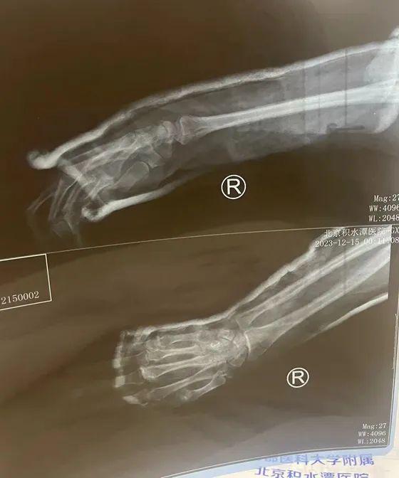 男子手部骨折变形，中医秒速复位惊艳众人