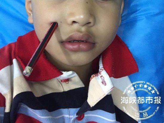 小孩被筷子戳穿事件，深度分析与反思