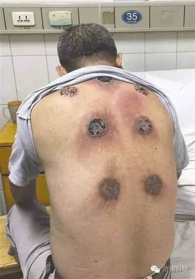 拔火罐致人死亡的案例解析
