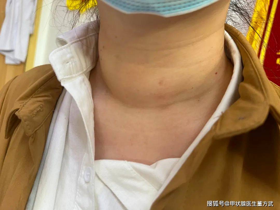 年轻女孩得了甲亢，如何治愈？