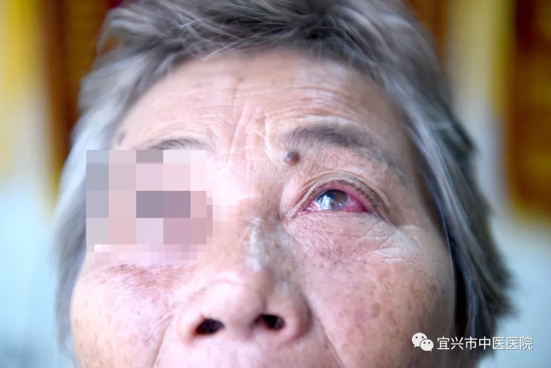 精神病患抠出老人眼球事件，官方回应与社会反响